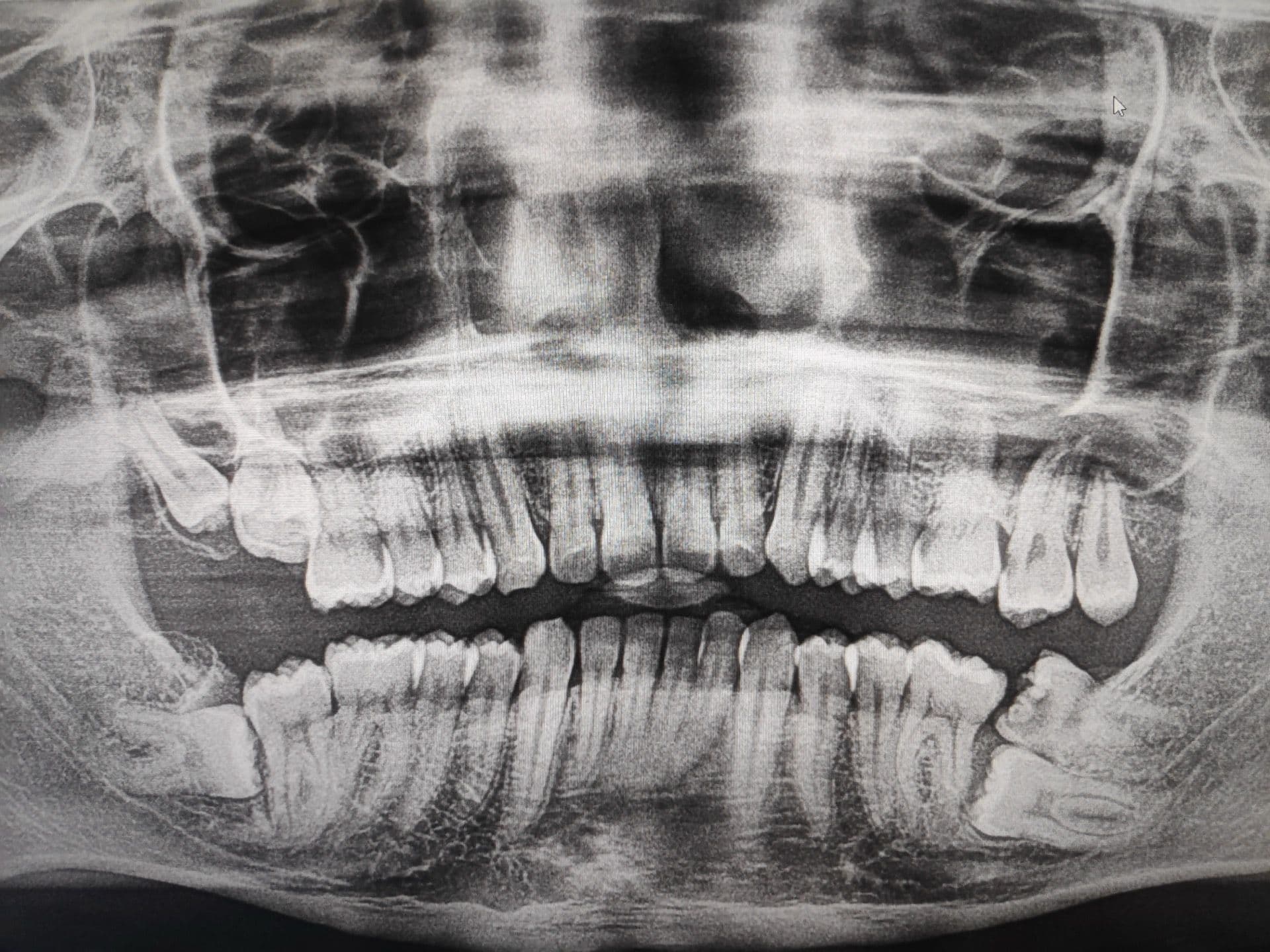 Лежачий зуб мудрости: дистопированная восьмёрка на рентгене
