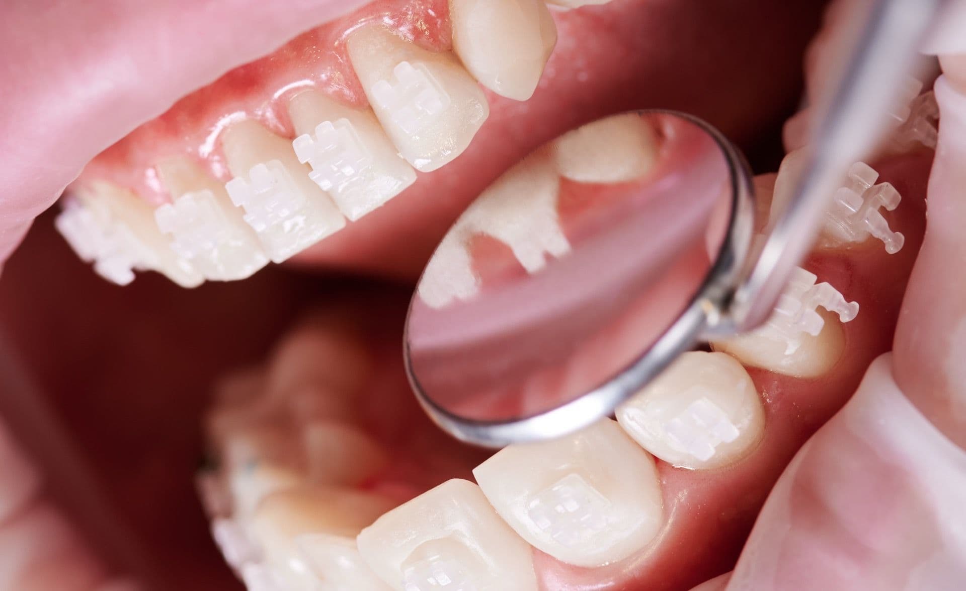 Разница между сапфировыми брекетами и керамическими Разница между сапфировыми брекетами и керамическими