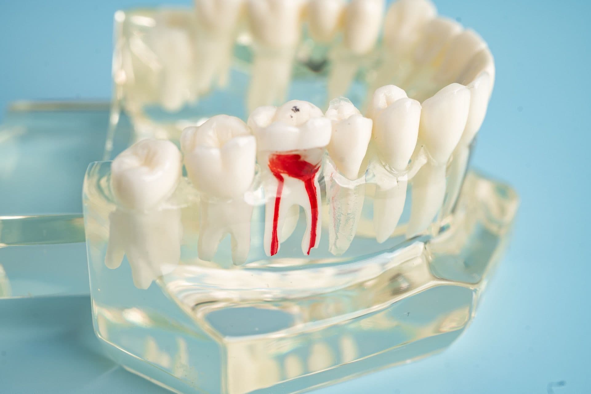 Воспалённые корневые каналы зуба и пульпа.