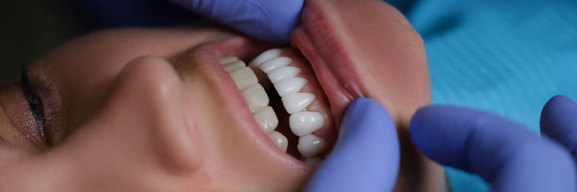 Самые дешёвые виниры Самые дешёвые виниры