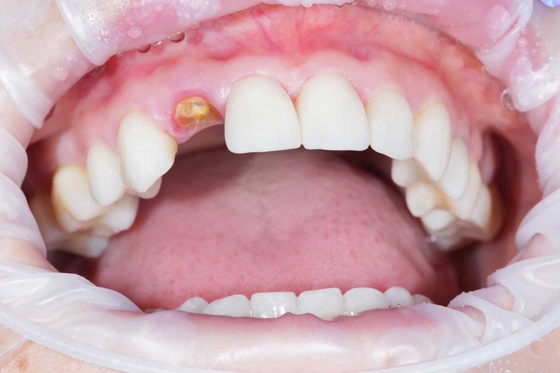 Полностью разрушенная наружная часть зуба и оставшийся корень.