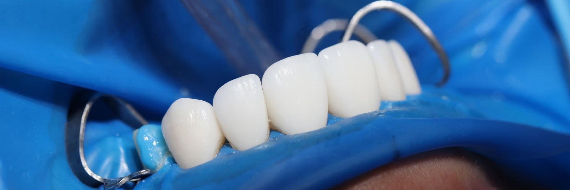 Так выглядят качественные композитные виниры. Они выполнены достаточно аккуратно, но имеют плотный цвет без полупрозрачного режущего края. 