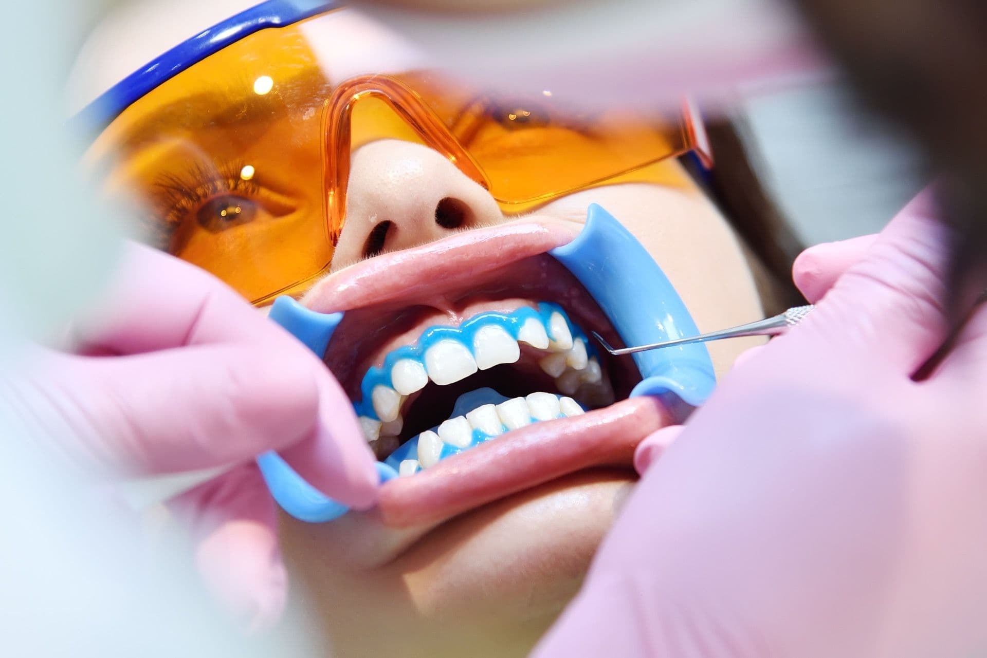 Вред отбеливания зубов Вред отбеливания зубов